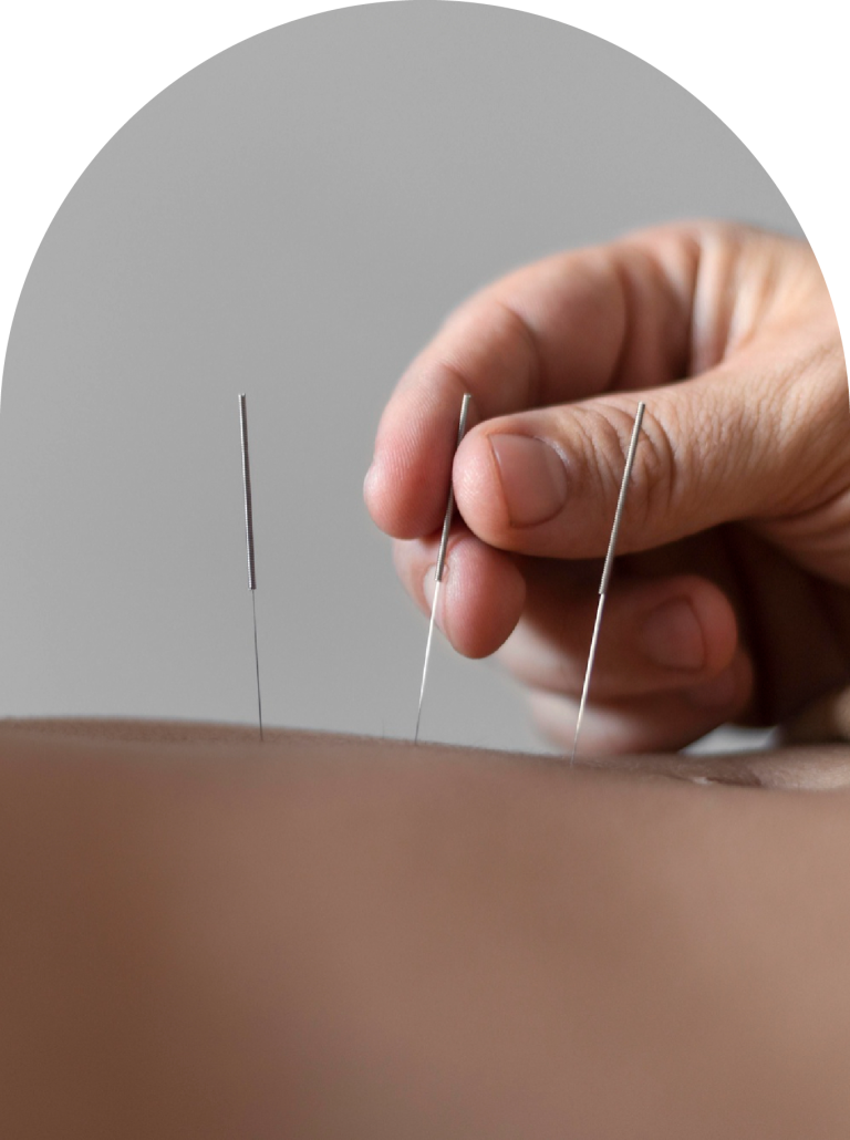 Consulta de Acupuntura